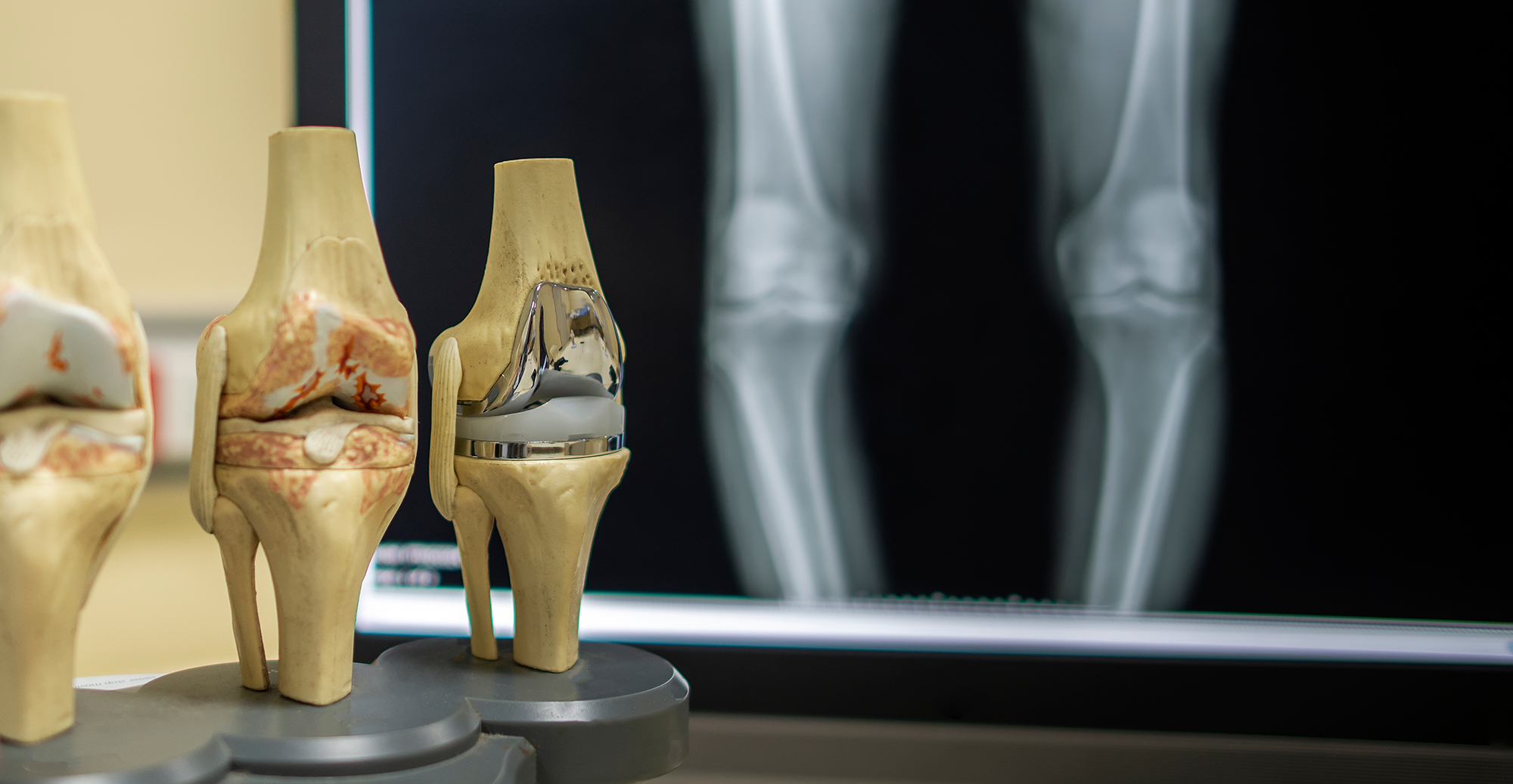 人工膝関節置換術の手術プロセス