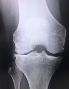 変形性膝関節症